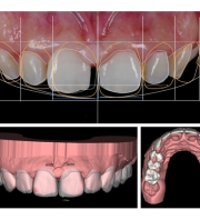 Dijital Smile Design (Dijital Gülüş Tasarımı)