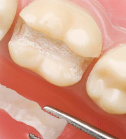 Restoratif diş tedavisi