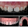 Dijital Smile Design (Dijital Gülüş Tasarımı)